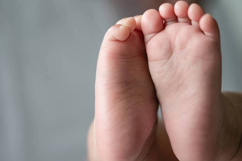 Tratamiento de Pie equino varo aducto congénito en Cuautitlán Izcalli, Méx.